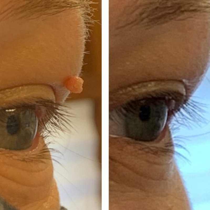 ClearSkin Tag Removal Kit