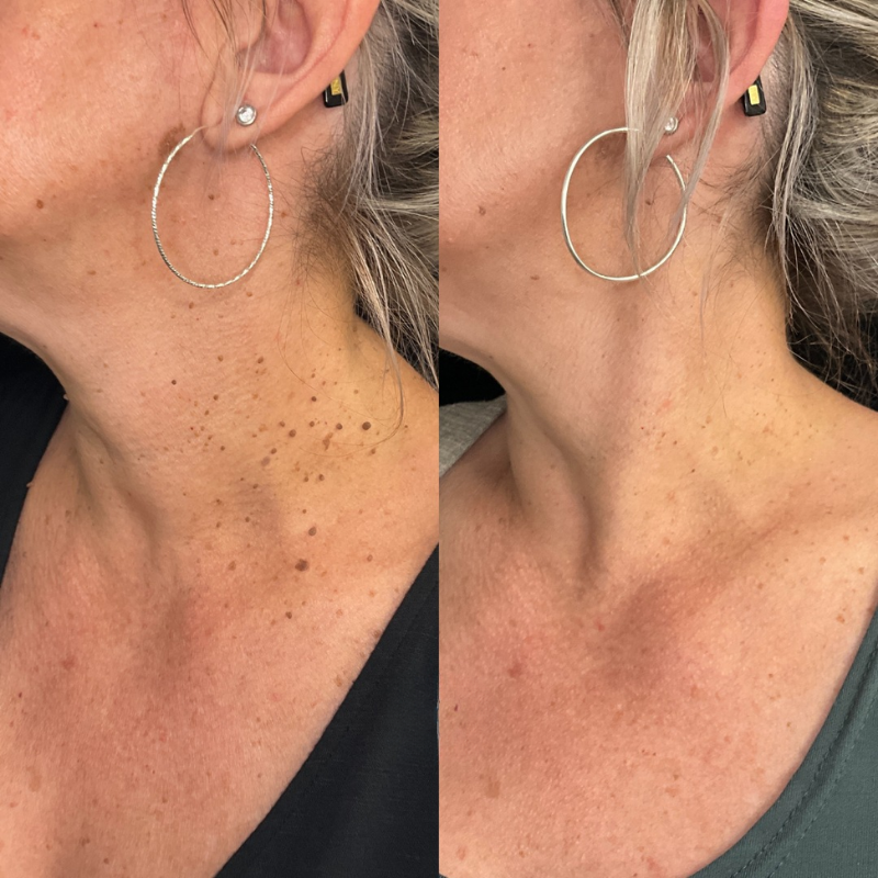ClearSkin Tag Removal Kit