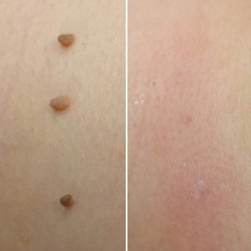 ClearSkin Tag Removal Kit