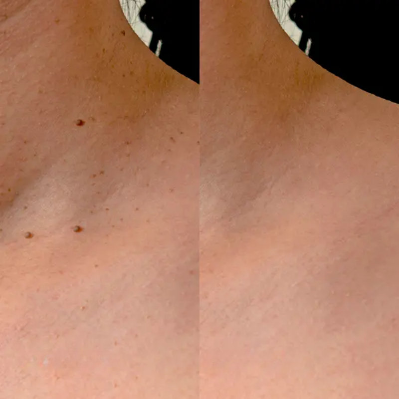 ClearSkin Tag Removal Kit