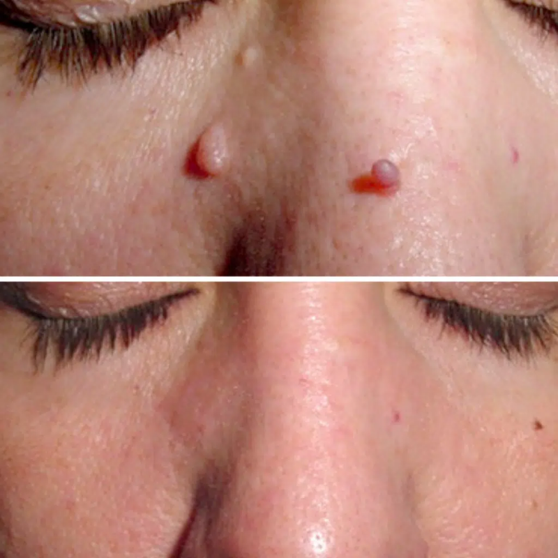 ClearSkin Tag Removal Kit