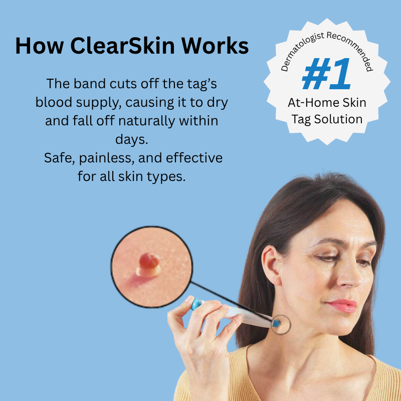 ClearSkin Tag Removal Kit