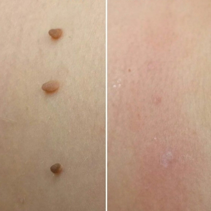 ClearSkin Tag Removal Kit